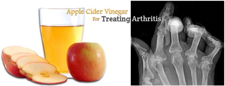 Apple Cider Vinegar for treating Arthritis