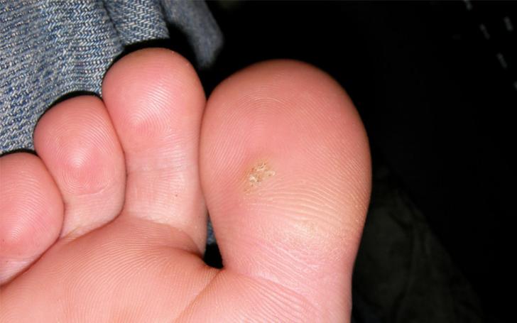 Planter wart removed with apple cider vinegar