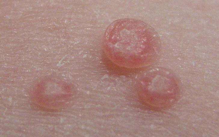 Warts can be skin colored, black or brown in color. It can be removed using Apple Cider Vinegar